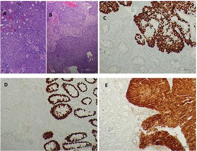 Case report of unusual synchronous anal and rectal squamous cell carcinoma: clinical and therapeutic lesson